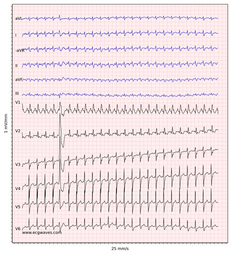 Atrial Flutter Ekg Atrial Flutter Ekg Abnormal Rhythm Abnormal The