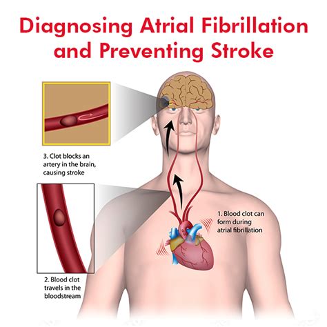 Diagnosing Atrial Fibrillation and Preventing Stroke | Dr Raghu