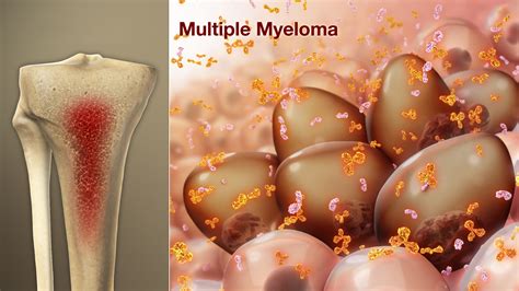 Multiple Myeloma Shown and Explained Using Medical Animation Still Shot