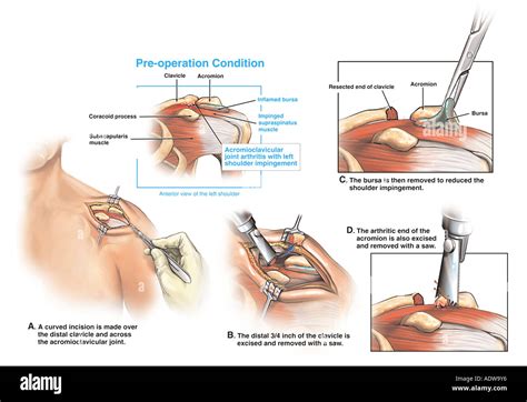 Acromioclavicular Joint Arthritis Treatment - Quotes Resume