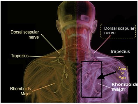 Dorsal scapular nerve | Patient information sheets