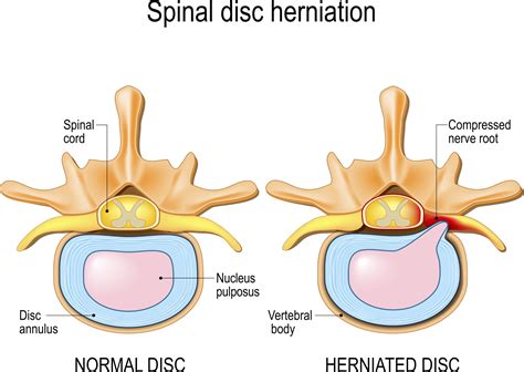 Herniated Disc In Neck Surgery - Bulging Disc vs. Herniated Disc ...