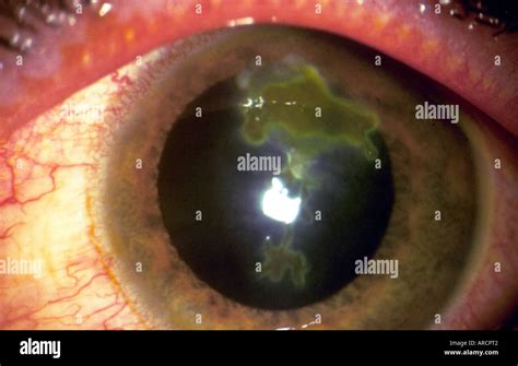 A photograph of a dendritic ulcer, a common and serious infection of ...