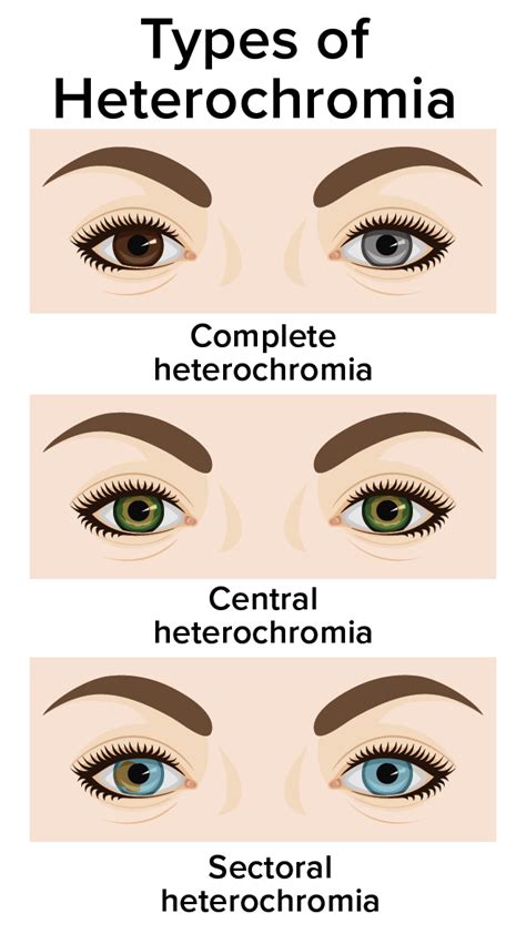 Types Of Heterochromia