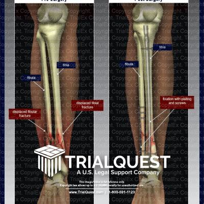 Tibia and fibula fracture - lopired