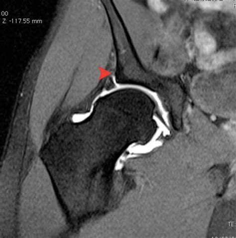 Hip labral tear mri contrast breastfeeding, what does a hip flexor feel ...