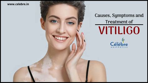 Preventing Vitiligo | Strategies for Minimizing Skin Depigmentation