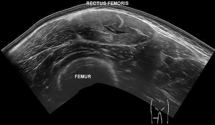 Rectus femoris muscle injury | Radiology Case | Radiopaedia.org