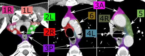 Mediastinal Lymph Nodes Map