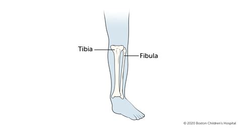 Broken Tibia-Fibula (Shinbone/Calf Bone) | Boston Children's Hospital