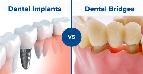 Missing teeth: Dental Bridge vs. Dental Implants – Alamo Heights ...