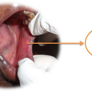 Complete response seen in left Buccal mucosal carcinoma after ...