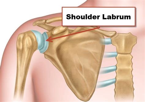 Superior Labral Tear