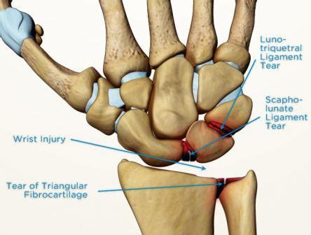 Scapholunate ligament injury - Melbourne Hand Surgery