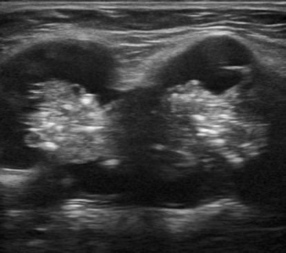 Cancerous Lymph Nodes In Neck Ultrasound