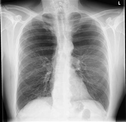 Pulmonary Emphysema X Ray