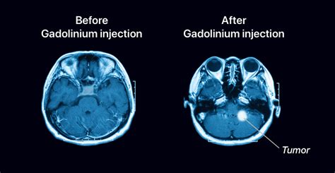 Gadolinium | What Is Gadolinium & What Is It Used for in MRIs?