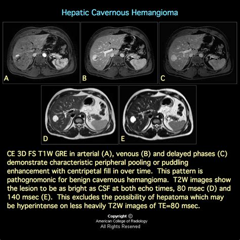 MRI BLOG: Hepatic Cavernous Hemangioma