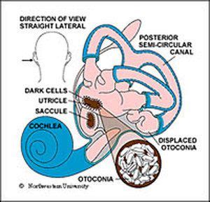 Inner Ear 'Rock Slides' Lead To Vertigo | Vertigo, Vertigo treatment ...