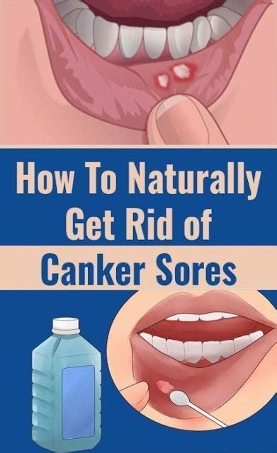 How to cure canker sores and mouth sores? | Healthy Prize