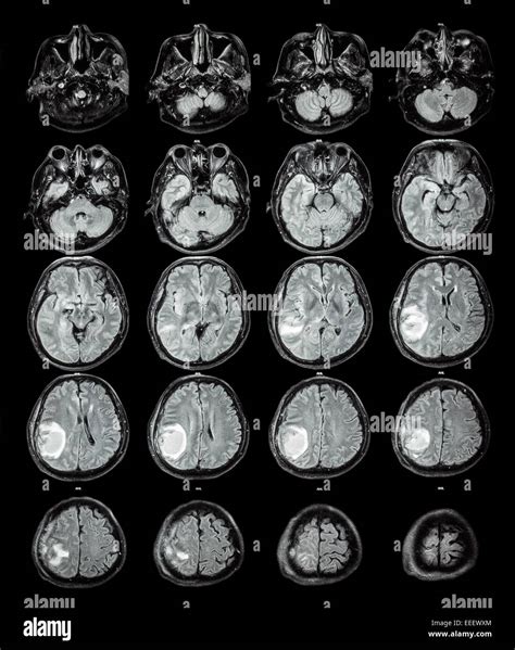 Brain Lobes Labeled Mri at Harold Cook blog