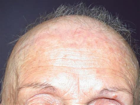 Causes and Treatment of Frontal Fibrosing Alopecia (FFA)