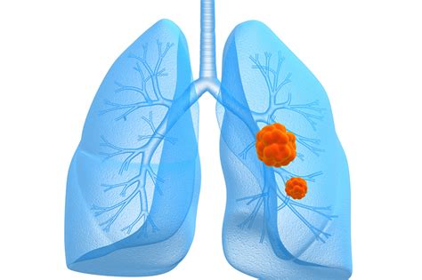 More Than a Cough: Lung Cancer Symptoms | UPMC