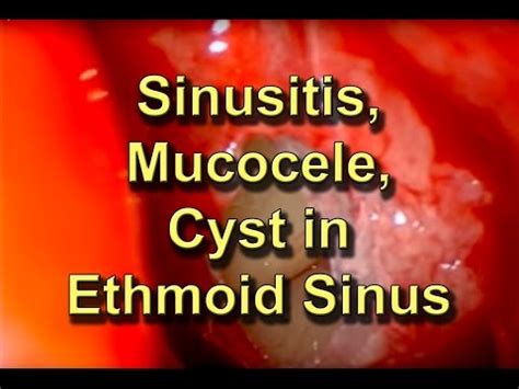 Preauricular Sinus and Cyst