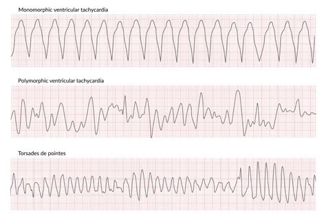 Nabızsız ventriküler taşikardi Tıpacı