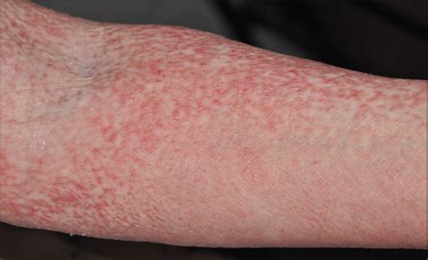 Skin Rash On Arms