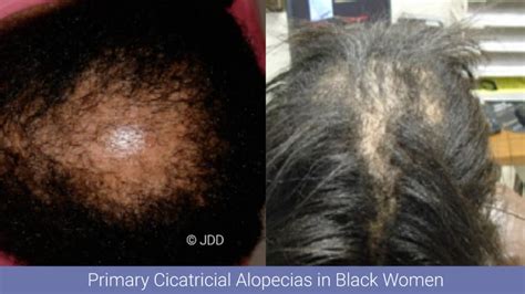 Non-Scarring and Scarring Alopecia | Beauty Beyond the Crown®