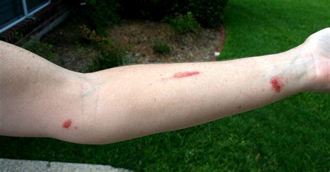 After working in garden, patient presents with raised lesions on forearm