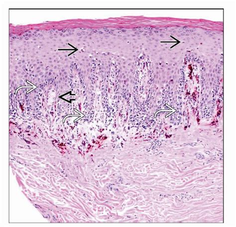 Acral Lentiginous Melanoma Histology