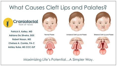 Cleft Lips and Palates - Dell Children's Craniofacial Team of Texas