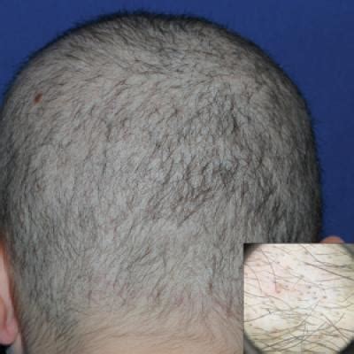 Diffuse Nonscarring Alopecia | MDedge Dermatology