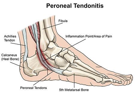 Best Running Shoes for Peroneal Tendonitis - The Runner's Base