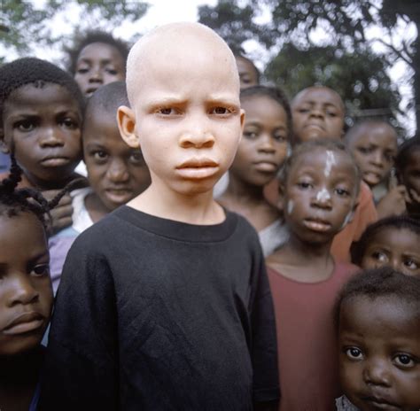 African albino boy. Albinoism is often demonized in Africa, with many ...