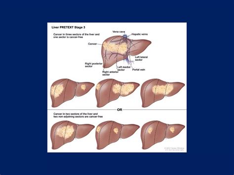 Surgical Anatomy of the Liver : Ηepatectomies - Dimitris P. Korkolis | PPT