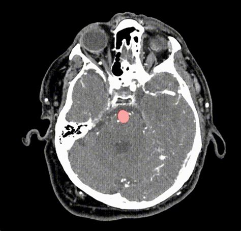 Brain Aneurysm Ct Scan - Diagnosis of a brain aneurysm may require ct ...