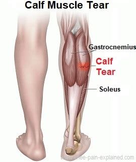 Calf Muscle Tear Treatment - Knee Pain Explained