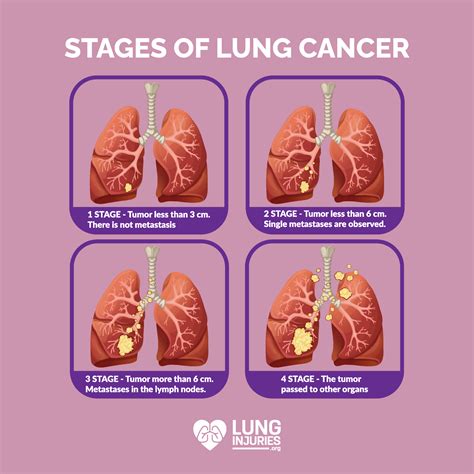 Stages Of Cancer