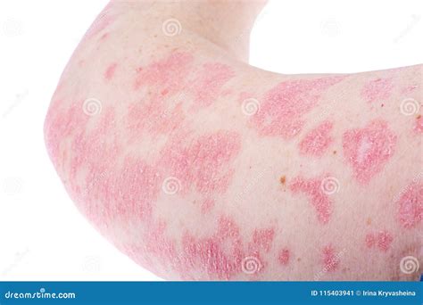 Dermatological Skin Disease Psoriasis More Pronounced On Elbow Hand