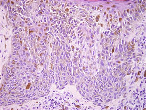 Benign Nevus Histology