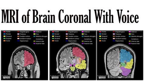 MRI of brain coronal with voice - YouTube