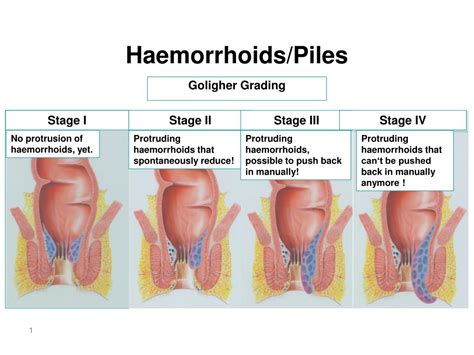 What-is-the-best-treatment-for-piles