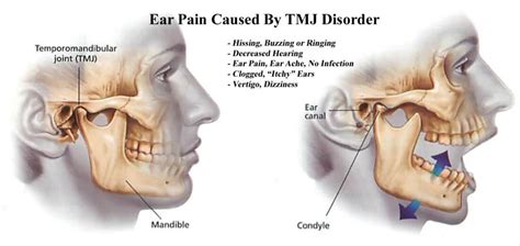 Ear Pain & Ringing | Head Pain Institute