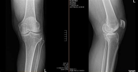 Case Study: Left Total Knee Arthroplasty in 66 yr. Old Male