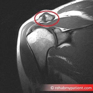 Acromioclavicular Osteoarthritis | Rehab My Patient