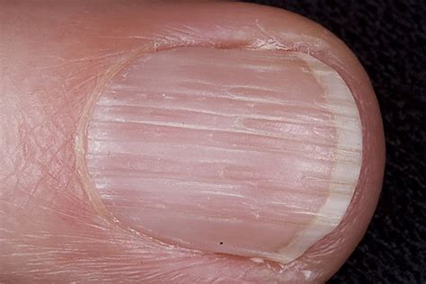 Vertical Lines On Fingernails Deficiency