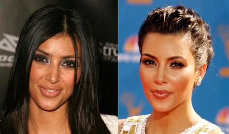 Kim Before And After Plastic Surgery